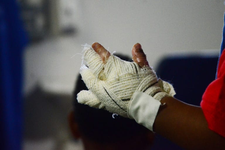 SES alerta para riscos de queimaduras no período junino