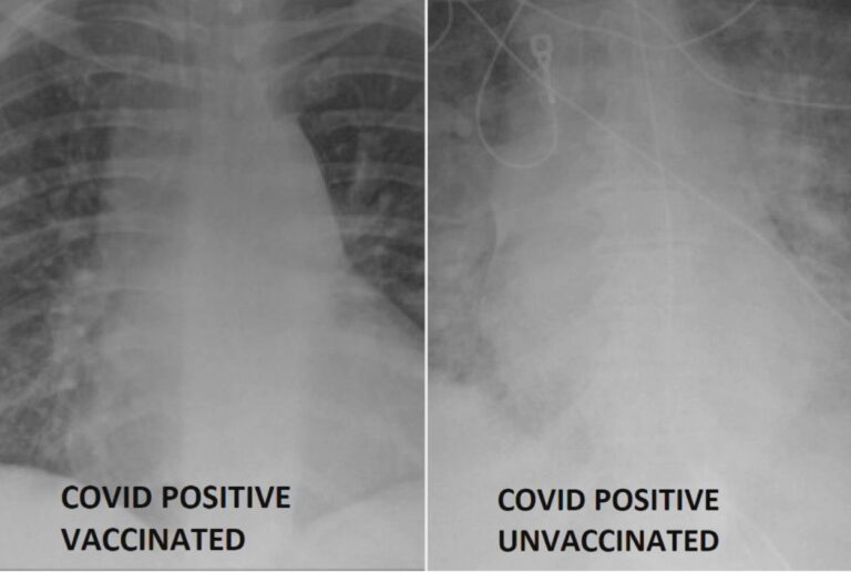 Raios X mostram diferença entre pacientes vacinados e não vacinados