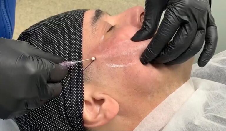 Fios de sustentação para o rosto são aliados no combate à flacidez facial