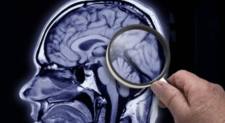 Maioria das pessoas não conhece os sintomas de Alzheimer precoce, diz pesquisa