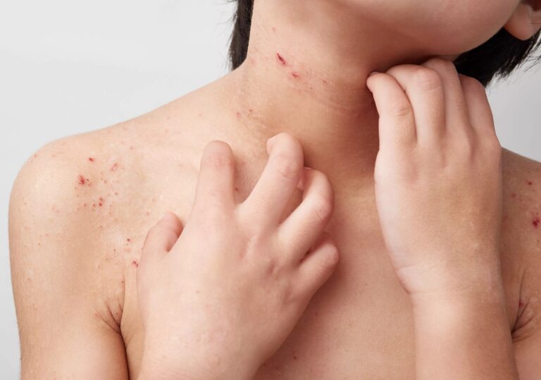 Anafilaxia: A reação alérgica mais grave e que pode levar a óbito