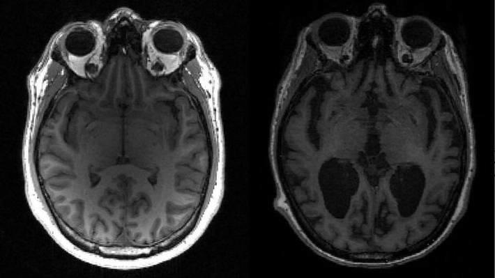Alzheimer: Cientistas descobrem novo método para prever risco antes do início dos sintomas