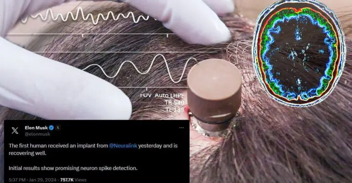 Neuralink, de Elon Musk, realiza primeiro implante de chip em cérebro humano