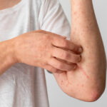 Dermatite Atópica afeta pele, mas impactos podem chegar ao sono e à vida social