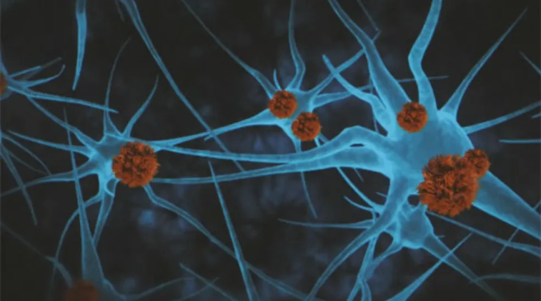 Droga que retarda a progressão do Alzheimer em estágios iniciais é eficaz, diz painel da FDA