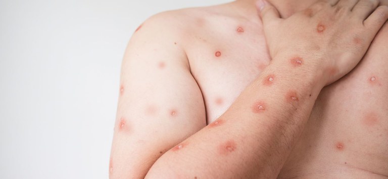 Mpox: cientistas alertam sobre ameaça global