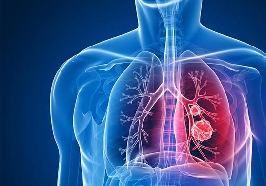 Novo teste portátil para detecção de tuberculose tem 100% de precisão