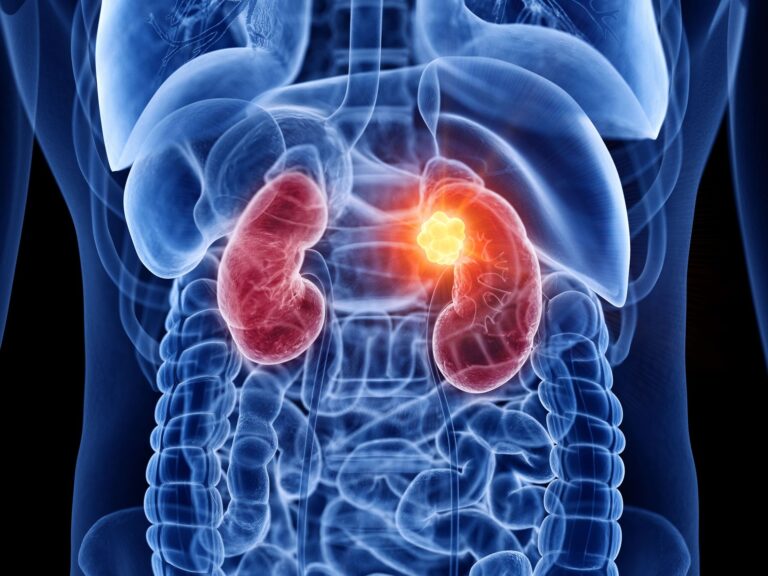 Câncer renal deve crescer quase 80% no Brasil e na América Latina até 2050