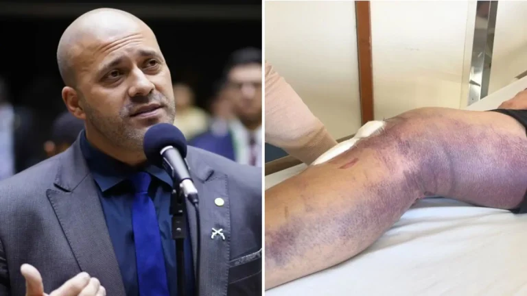 Moraes autoriza saídas temporárias de Daniel Silveira da prisão para tratamento pós-operatório