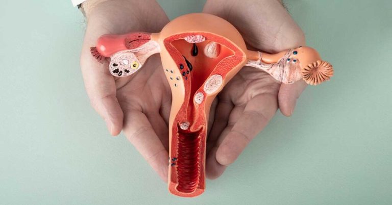 Endometriose afeta 8 milhões de brasileiras