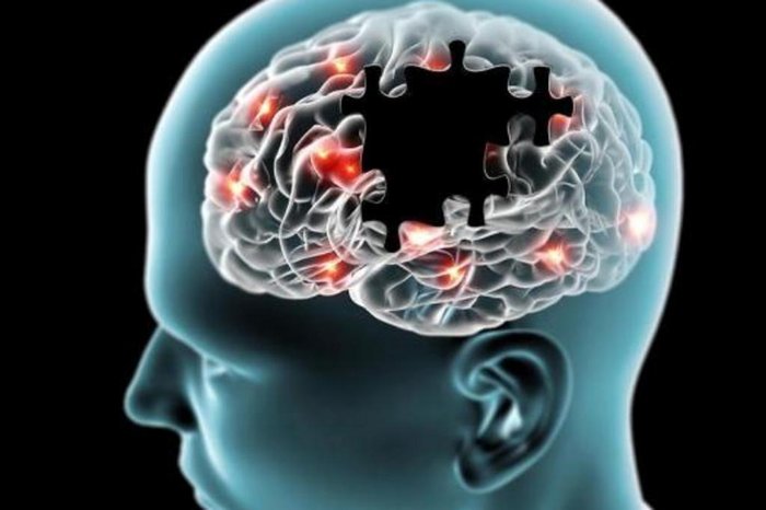 Alzheimer: novo medicamento pode reduzir declínio cognitivo em 50%