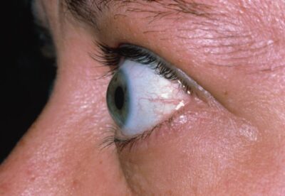 Autoimune, Doença Ocular da Tireoide pode fazer com que olhos saltem, provocando alteração estética e até cegueira