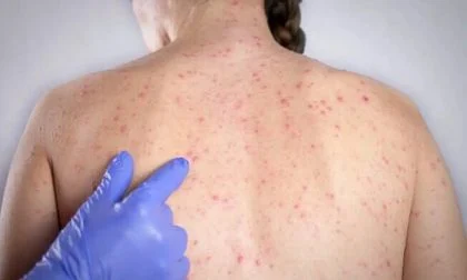 Nenhum estado brasileiro atinge meta de vacinação contra o sarampo; surtos em países vizinhos preocupam